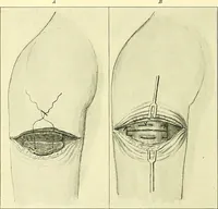 Picture 66 of 481 from Modern surgery, general and operative / by John Chalmers Da Costa. (1907), leaf 252