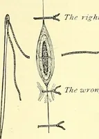 An illustration from Modern surgery, general and operative / by John Chalmers Da Costa. (1907)
