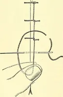 Picture 69 of 481 from Modern surgery, general and operative / by John Chalmers Da Costa. (1907), leaf 254