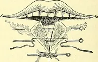 Picture 72 of 481 from Modern surgery, general and operative / by John Chalmers Da Costa. (1907), leaf 256