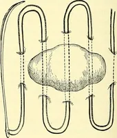 Picture 76 of 481 from Modern surgery, general and operative / by John Chalmers Da Costa. (1907), leaf 320