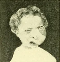 An illustration from Modern surgery, general and operative / by John Chalmers Da Costa. (1907)