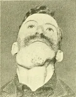 An illustration from Modern surgery, general and operative / by John Chalmers Da Costa. (1907)