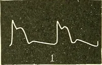 Picture 84 of 481 from Modern surgery, general and operative / by John Chalmers Da Costa. (1907), leaf 366