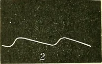 Picture 85 of 481 from Modern surgery, general and operative / by John Chalmers Da Costa. (1907), leaf 366