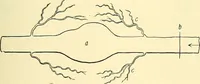 Picture 86 of 481 from Modern surgery, general and operative / by John Chalmers Da Costa. (1907), leaf 371
