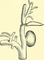 Picture 87 of 481 from Modern surgery, general and operative / by John Chalmers Da Costa. (1907), leaf 372
