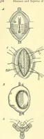 Picture 89 of 481 from Modern surgery, general and operative / by John Chalmers Da Costa. (1907), leaf 374
