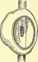 Picture 90 of 481 from Modern surgery, general and operative / by John Chalmers Da Costa. (1907), leaf 374