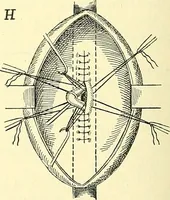 Picture 92 of 481 from Modern surgery, general and operative / by John Chalmers Da Costa. (1907), leaf 374