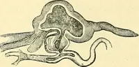 Picture 93 of 481 from Modern surgery, general and operative / by John Chalmers Da Costa. (1907), leaf 377