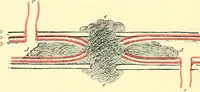 Picture 94 of 481 from Modern surgery, general and operative / by John Chalmers Da Costa. (1907), leaf 380