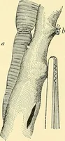 An illustration from Modern surgery, general and operative / by John Chalmers Da Costa. (1907)