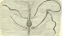 Picture 100 of 481 from Modern surgery, general and operative / by John Chalmers Da Costa. (1907), leaf 386