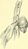 An illustration from Modern surgery, general and operative / by John Chalmers Da Costa. (1907)