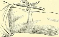 Picture 103 of 481 from Modern surgery, general and operative / by John Chalmers Da Costa. (1907), leaf 388