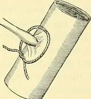 Picture 107 of 481 from Modern surgery, general and operative / by John Chalmers Da Costa. (1907), leaf 393