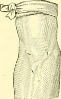 Picture 109 of 481 from Modern surgery, general and operative / by John Chalmers Da Costa. (1907), leaf 404