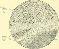 Picture 112 of 481 from Modern surgery, general and operative / by John Chalmers Da Costa. (1907), leaf 410