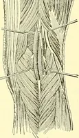 Picture 115 of 481 from Modern surgery, general and operative / by John Chalmers Da Costa. (1907), leaf 436