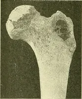 Picture 117 of 481 from Modern surgery, general and operative / by John Chalmers Da Costa. (1907), leaf 448