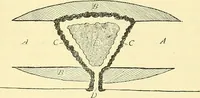 An illustration from Modern surgery, general and operative / by John Chalmers Da Costa. (1907)