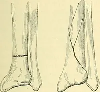 Picture 119 of 481 from Modern surgery, general and operative / by John Chalmers Da Costa. (1907), leaf 461