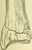 Picture 126 of 481 from Modern surgery, general and operative / by John Chalmers Da Costa. (1907), leaf 463