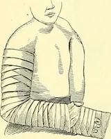 Picture 150 of 481 from Modern surgery, general and operative / by John Chalmers Da Costa. (1907), leaf 508