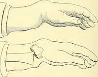 An illustration from Modern surgery, general and operative / by John Chalmers Da Costa. (1907)