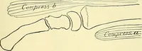 Picture 160 of 481 from Modern surgery, general and operative / by John Chalmers Da Costa. (1907), leaf 525