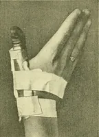 An illustration from Modern surgery, general and operative / by John Chalmers Da Costa. (1907)
