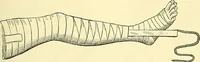 Picture 163 of 481 from Modern surgery, general and operative / by John Chalmers Da Costa. (1907), leaf 533