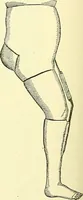 Picture 174 of 481 from Modern surgery, general and operative / by John Chalmers Da Costa. (1907), leaf 544