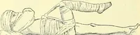 An illustration from Modern surgery, general and operative / by John Chalmers Da Costa. (1907)