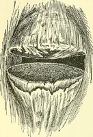 Picture 176 of 481 from Modern surgery, general and operative / by John Chalmers Da Costa. (1907), leaf 550