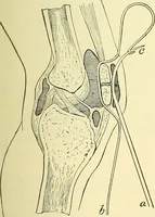 An illustration from Modern surgery, general and operative / by John Chalmers Da Costa. (1907)