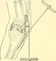Picture 177 of 481 from Modern surgery, general and operative / by John Chalmers Da Costa. (1907), leaf 552