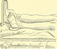 An illustration from Modern surgery, general and operative / by John Chalmers Da Costa. (1907)