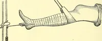 An illustration from Modern surgery, general and operative / by John Chalmers Da Costa. (1907)