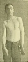 Picture 187 of 481 from Modern surgery, general and operative / by John Chalmers Da Costa. (1907), leaf 605
