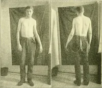An illustration from Modern surgery, general and operative / by John Chalmers Da Costa. (1907)
