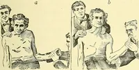 An illustration from Modern surgery, general and operative / by John Chalmers Da Costa. (1907)