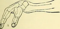 An illustration from Modern surgery, general and operative / by John Chalmers Da Costa. (1907)