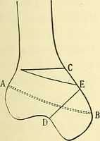 An illustration from Modern surgery, general and operative / by John Chalmers Da Costa. (1907)