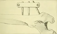 Picture 207 of 481 from Modern surgery, general and operative / by John Chalmers Da Costa. (1907), leaf 635