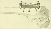 Picture 208 of 481 from Modern surgery, general and operative / by John Chalmers Da Costa. (1907), leaf 636