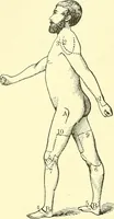 Picture 212 of 481 from Modern surgery, general and operative / by John Chalmers Da Costa. (1907), leaf 640