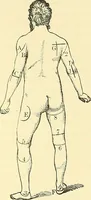 An illustration from Modern surgery, general and operative / by John Chalmers Da Costa. (1907)
