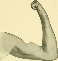 An illustration from Modern surgery, general and operative / by John Chalmers Da Costa. (1907)